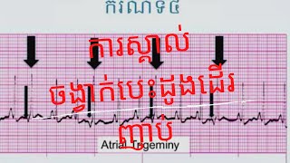 Tachyarrhythmia  ការស្គាល់ចង្វាក់បេះដូងដើរញាប់ [upl. by Barbabra]