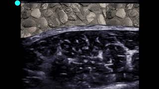 POCUS  Soft Tissue Ultrasound  Cobblestoning [upl. by Dunn]