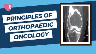 Principles of Orthopaedic Oncology and Bone Tumours for the FRCS Ortho Exam [upl. by Mllly]