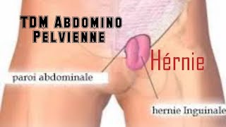 SCANNER ABDOMINOPELVIEN  Hernie inguinale [upl. by Eikkin]