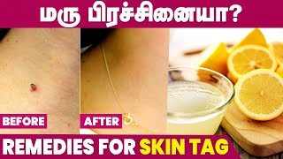 How to remove Skin Tag at Home  Skin Maru Removal Tamil [upl. by Leod]