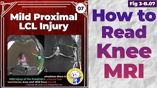 Fig 3B07 Mild Proximal LCL Injury [upl. by Vinn587]