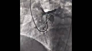 Anamolous RCA inf STEMI primary pci of Anamolous RCA [upl. by Lorry61]