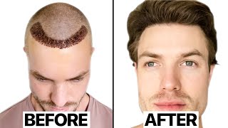 My Hair Transplant Results 6 Months  Surgeon Reacts [upl. by Lyrahs]