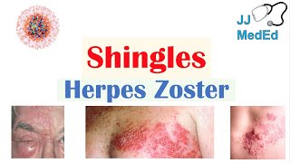 Shingles Herpes Zoster Pathophysiology Risk Factors Phases of Infection Symptoms Treatment [upl. by Billmyre]