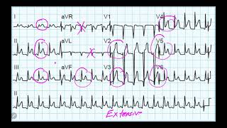 IM Cardiology 19 Pericardial diseases Acute pericarditis pericardial effusion and tamponade [upl. by Pate]