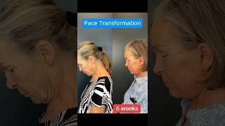 6 Week Update Facelift Transformation Surgeon Reacts facelift [upl. by Milicent770]