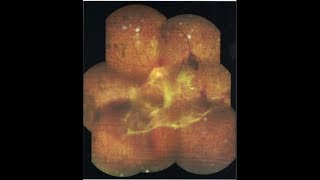 Vitreous Adhesions Diagnosis amp Treatment [upl. by Schubert]