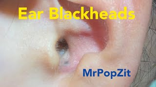 Ear Blackhead extractionsDeep in the ear blackheadsQuick extractions one dry one juicy MrPopZit [upl. by Sivie]