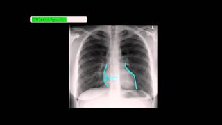 Chest XRay Reading Method  ABCDE UndergroundMed [upl. by Amary]