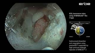 ESD of a LSTNG tumor at the splenic flexure using HYBRIDknife® flex IType [upl. by Ryun]