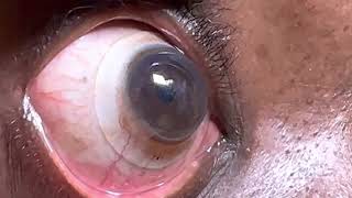 EyePrint Pro Scleral Lens Over An Eye With Advanced Keratoconus With Hydrops [upl. by Lawry]