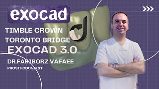 How to design a Toronto bridge thimble crown  step by step in exocad 30 Galway [upl. by Enaillil61]