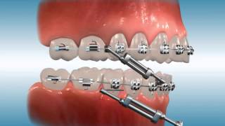 Twin Force® Bite Corrector for Class II Correction [upl. by Panayiotis145]