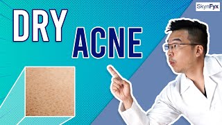 How To Treat Dry Skin  Acne Dry Acne  5 Tips To Follow [upl. by Odinevneib553]