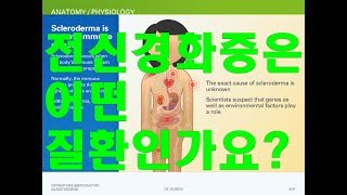 전신경화증과 사례Systemic Sclerosis [upl. by Luane273]