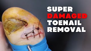 Super DAMAGED Toenail REMOVAL [upl. by Cyrille]