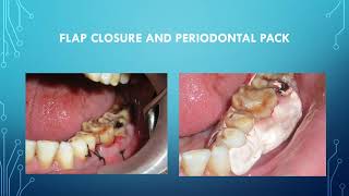 Furcation management by GTR [upl. by Secnarf]