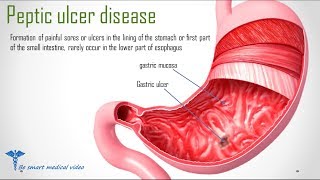 Quick review Peptic Ulcer Disease  Causes treatment [upl. by Noside]