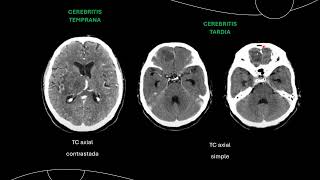 Absceso cerebral y Cisticercosis cerebral [upl. by Ahsikcin607]