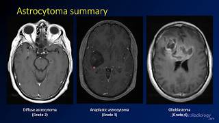 Imaging brain tumors  2  Astrocytomas [upl. by Zirkle]