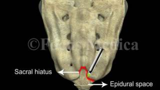 Caudal epidural anesthesia  Back and Spinal Cord [upl. by Eiramnna677]