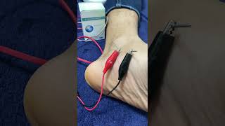 Dry needling  Tendinite de jambier posterieur douleur au pied [upl. by Jet671]