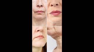 Skin tightening and lifting without needles Sofwaveskincare [upl. by Regnij]