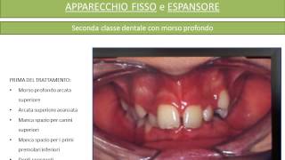 Apparecchio fisso e Espansore Prima e Dopo [upl. by Kata]