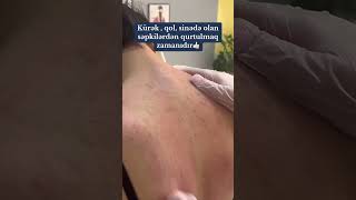 KÜRƏK AKNESİ  DERMATOLOQ [upl. by Avivah]