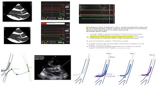 Impella concepts troubleshooting scenarios weaning sheath management Elias Hanna [upl. by Bowes]