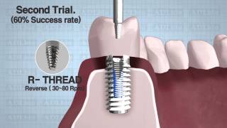 ADLbio Total implant removal [upl. by Aubree]