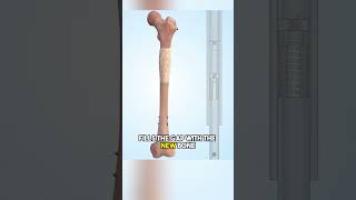 Limb Lengthening science medfacts medifact medicaleducation facts medicalscience [upl. by Aneelahs]