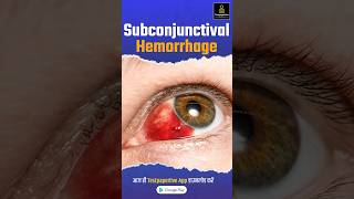 Subconjunctival Hemorrhage Blood in Eye Subconjunctival hemorrhage Eye [upl. by Shari999]