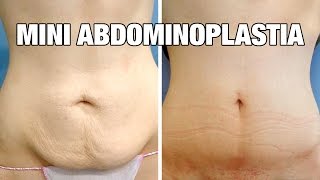 Mini Abdominoplastia antes y después  Testimonio Cristina [upl. by Tufts]