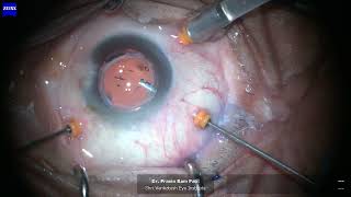 Epiretinal Membrane Removal  Vitrectomy done using Zeiss Quatera 700 Anterior Vitrectomy Probe [upl. by Ester]