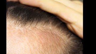 Regrow hair 100 and Stop hair fall Stop hair grey with simple tips [upl. by Marti643]