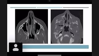 Choanal Atresia  Dr Atheer Ali [upl. by Tlaw]