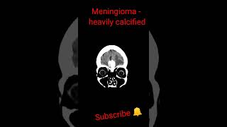 Meningioma heavily calcified shorts trending education [upl. by Truman435]