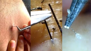 Ingrown Hair Removal  Satisfying Ingrown Hair 6 [upl. by Langsdon]