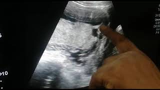 Placenta Previa  Major Posterior Placenta Previa [upl. by Tory506]