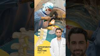 Treatment of Osteoporotic spine fracture  Dr Dheeraj Batheja  Part 2 doctor spinehealth [upl. by Ahcim]