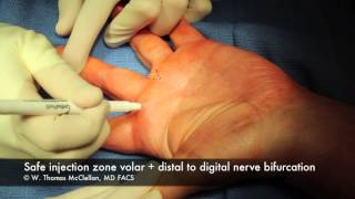 Live Surgery Digital Block Anesthesia of the Finger [upl. by Sorazal847]