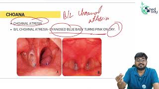 Choanal Atresia  By Dr Shubham Mittal  ENT [upl. by Batory]