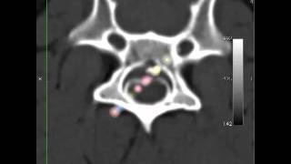 veterinary CT pet animal dog myelography [upl. by Aikimat]