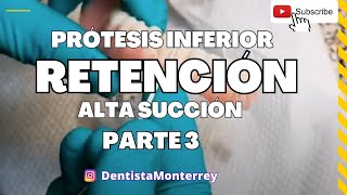 🔥🔥🔥 Prótesis INFERIOR👅ALTA SUCCIÓN Parte3 Resultado [upl. by Bainter]