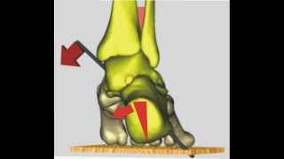 Il valgismo del calcagno supina lavampiede [upl. by Richey]
