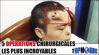 5 OPÉRATIONS Chirurgicales Les Plus INCROYABLES [upl. by Assenar]