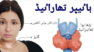 Thyroid  گلھڑ کا مرض Hyperthyroidism  Wajoohaat Nishaniyan ilaj [upl. by Eiddal]