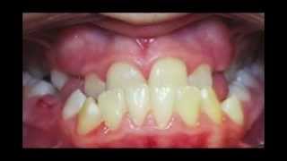 Underbite Correction Time Lapse Video Kyger Orthodontics [upl. by Salohcin535]